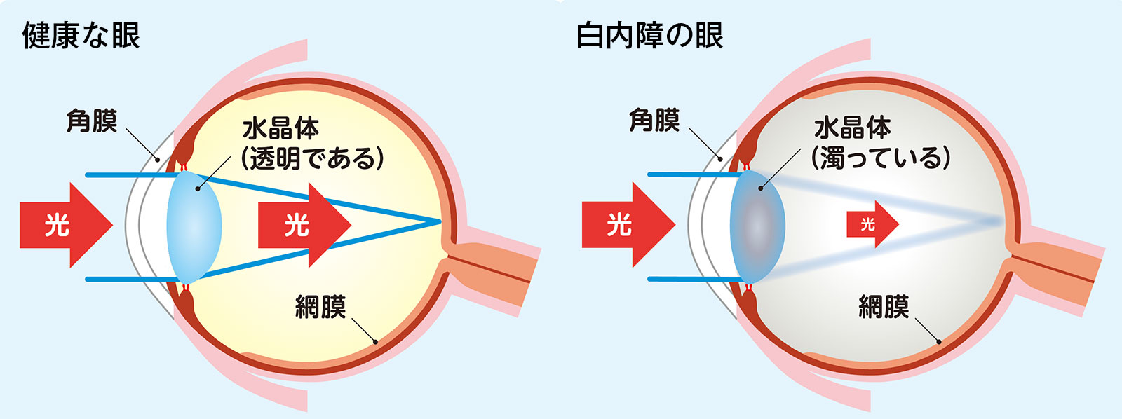 白内障